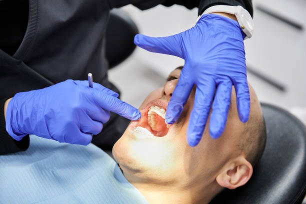 Best Emergency Wisdom Tooth Extraction in Fort Polk South, LA