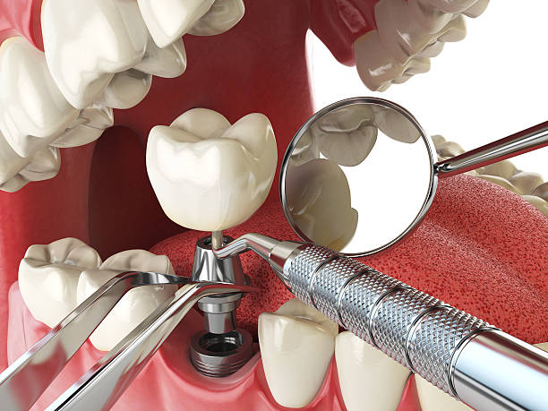 Best Emergency Root Canal Therapy in Fort Polk South, LA